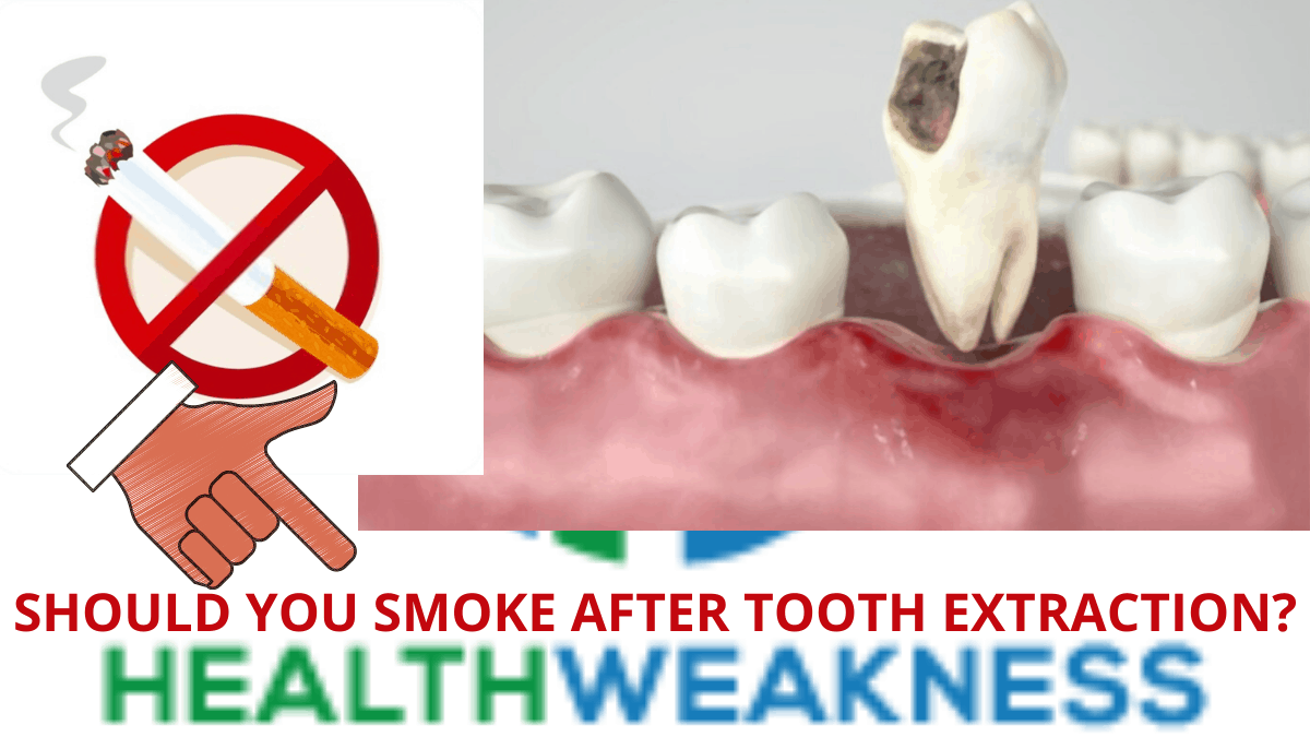 Must You Smoke After Tooth Extraction? READ THIS FIRST! » HealthWeakness