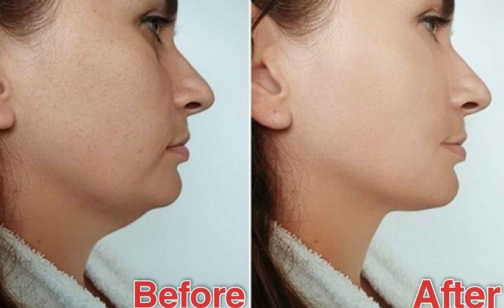How to Get Rid of a Double Chin Without Surgery