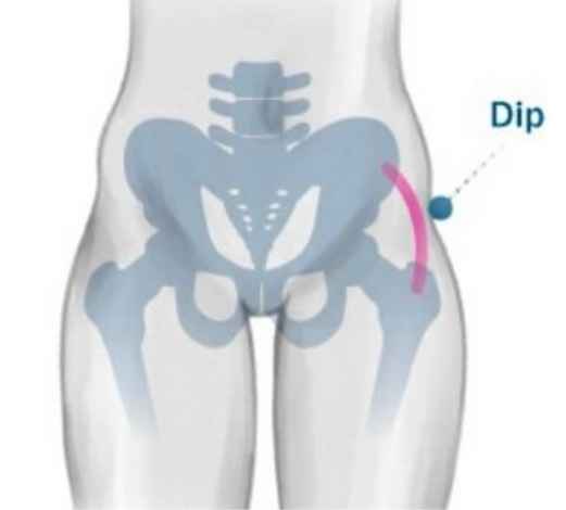 Hip Dips Surgery