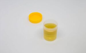 Bright yellow urine an early pregnancy test