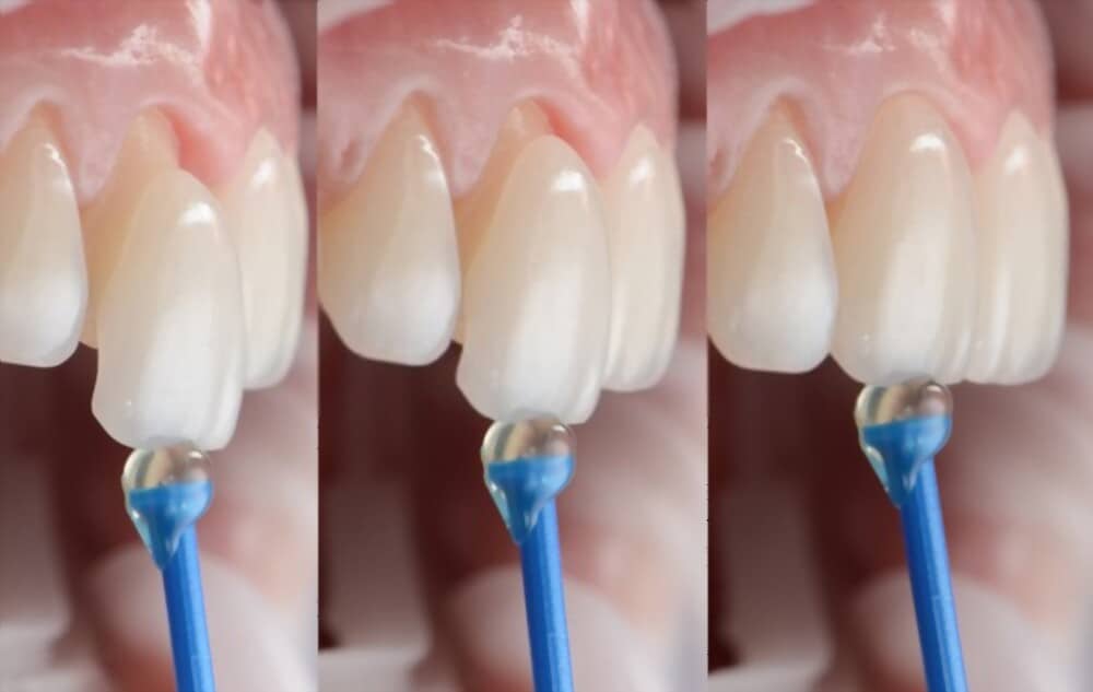 how long veneers last on teeth
