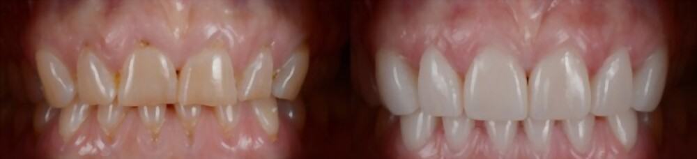 how long do veneers last on teeth